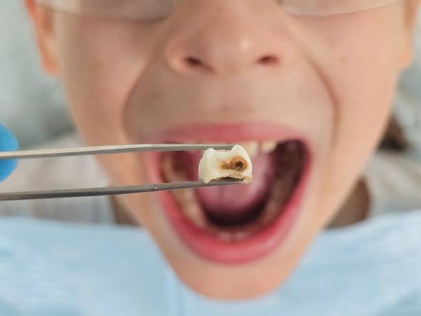 Best Emergency Dental Care for Broken or Chipped Teeth in Ixonia, WI