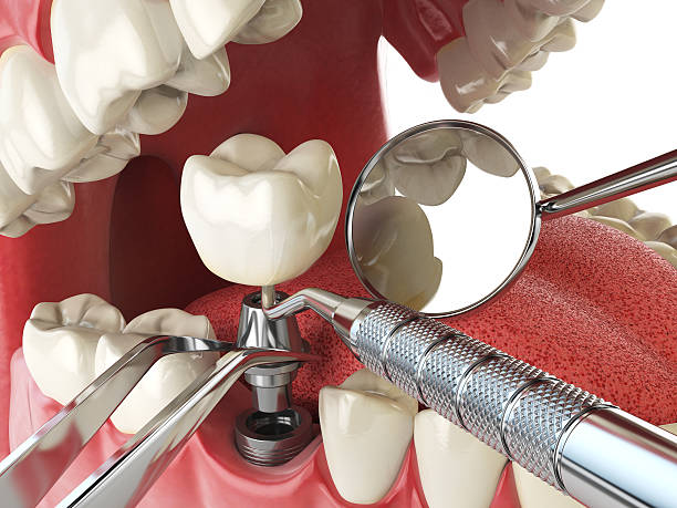 Best Emergency Denture Repair in Ixonia, WI